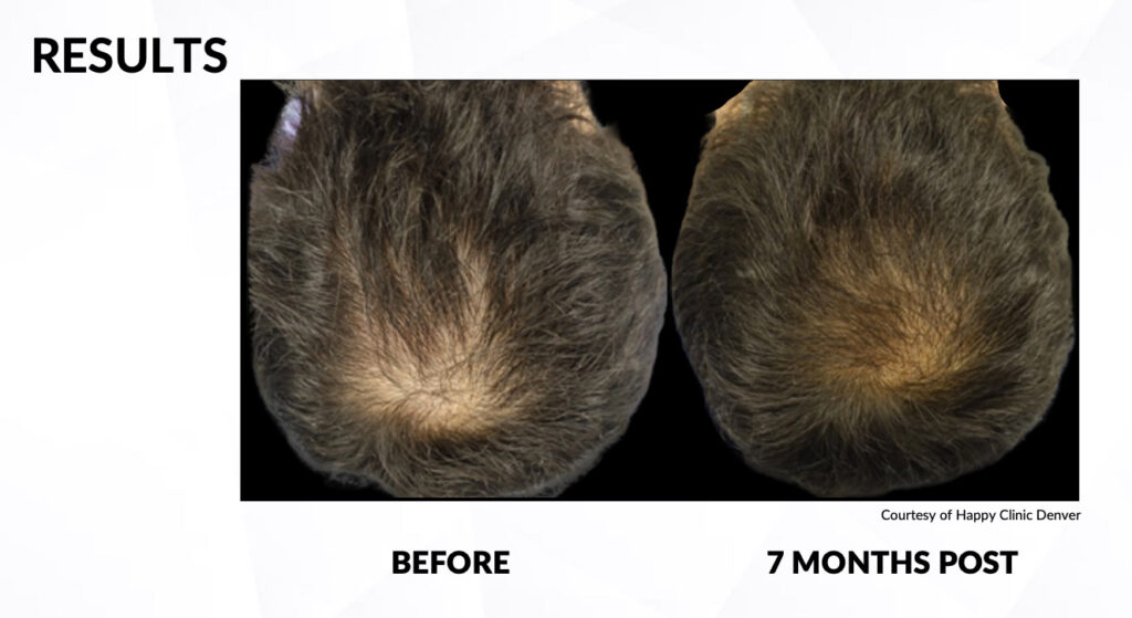 Laser Hair Removal Kamloops Beautiful U